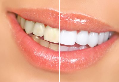 Dentisterie esthétique