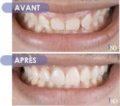 Avant-Après 4