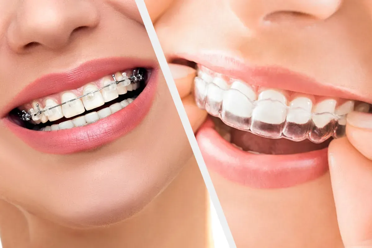 Orthodontie adulte à Agadir : aligneurs transparents ou bagues ?