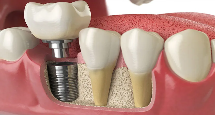 Implant dentaire à Agadir : les étapes, la durée et ce qu'il faut savoir